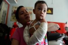 Phụ huynh bức xúc vì con bị gãy tay ở nhà trẻ