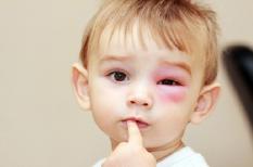 Xử lý nhanh ra sao khi trẻ bị ong đốt tại nhà?